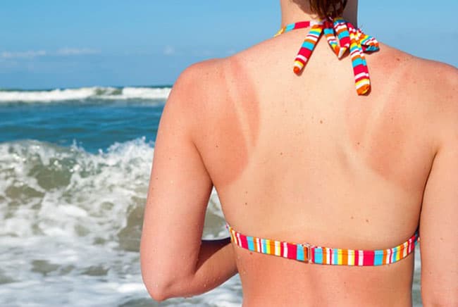 Cháy nắng xảy ra khi da bạn tiếp xúc với quá nhiều tia cực tím (UV) từ mặt trời.
