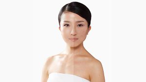 Tìm hiểu nám da mặt và phương pháp hỗ trợ điều trị nám da hiệu quả