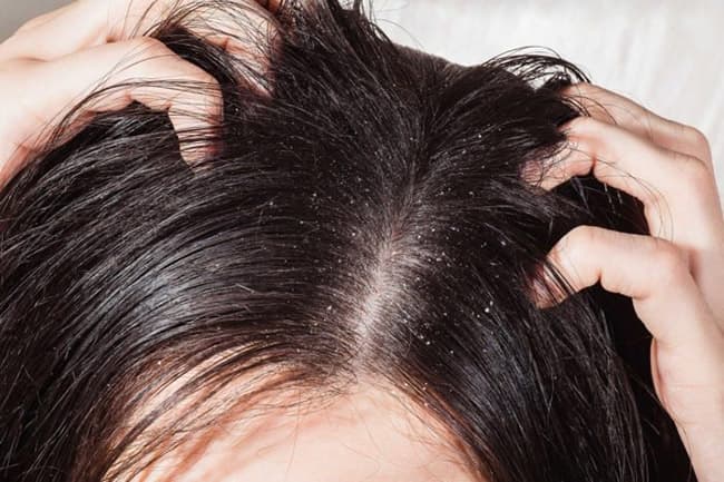 Dầu gội chứa thành phần độc hại gây kích ứng da đầu.