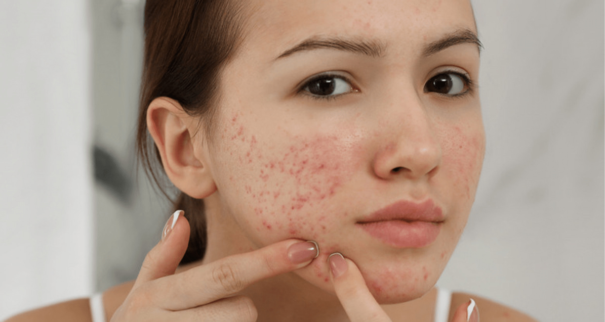 Cần phải xác định đúng tình trạng mụn