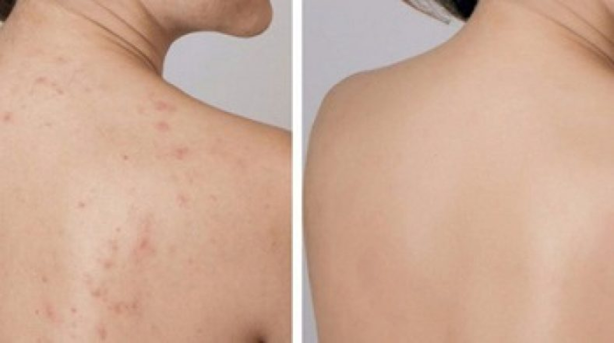 Hình ảnh trước và sau sử dụng xịt mụn lưng Labcos