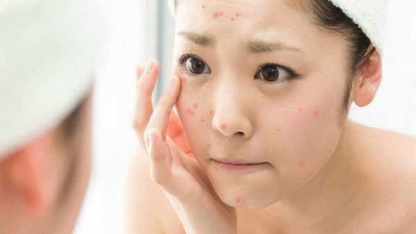 Bị mụn viêm, sưng tấy – Đâu là cách hỗ trợ điều trị hiệu quả?