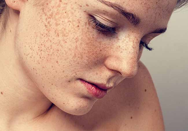 Tình trạng da sản xuất quá nhiều hắc tố Melanin gây nám.