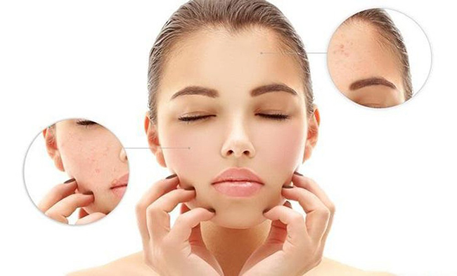 Sản phẩm dành riêng cho làn da mụn