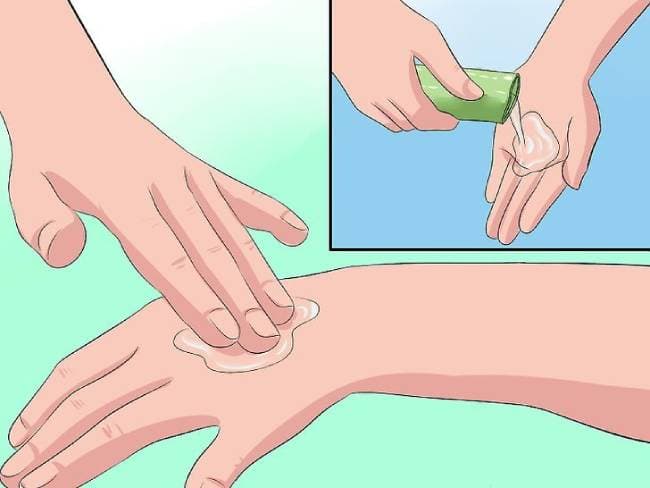 điều trị bỏng với gel nha đam