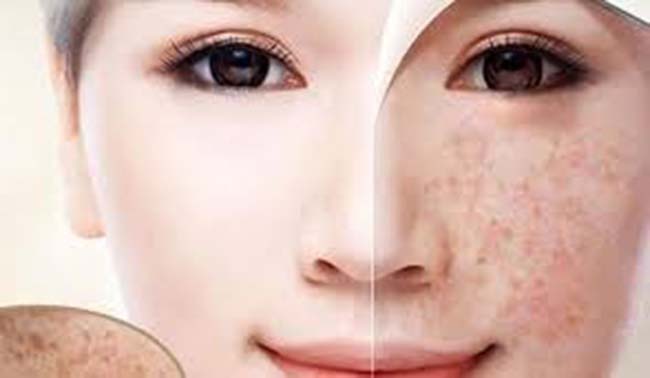 Mequinol thành phần luôn có mặt trong serum trị nám