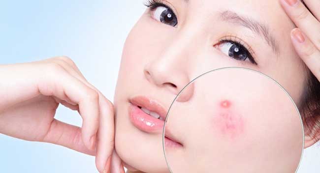 Mụn xuất hiện ở hầu hết tất cả mọi người.