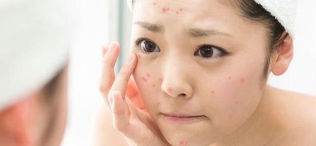 Tình trạng mụn có thể xuất hiện ở mọi độ tuổi.