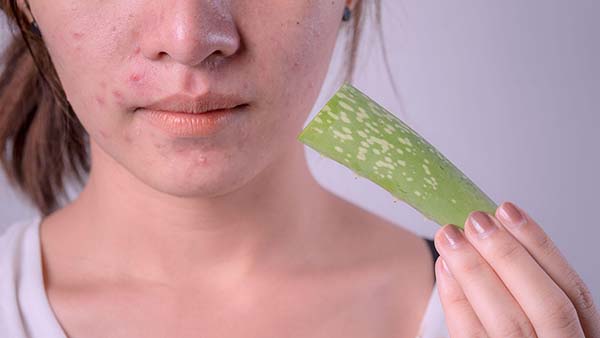 10 cách hỗ trợ trị mụn hiệu quả với nguyên liệu Nha Đam
