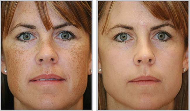 Retinoid được xem là thành phần vàng trong điều trị nám da.