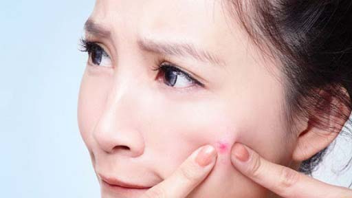 Làm thế nào để thoát khỏi mụn? Phương pháp trị mụn tự nhiên